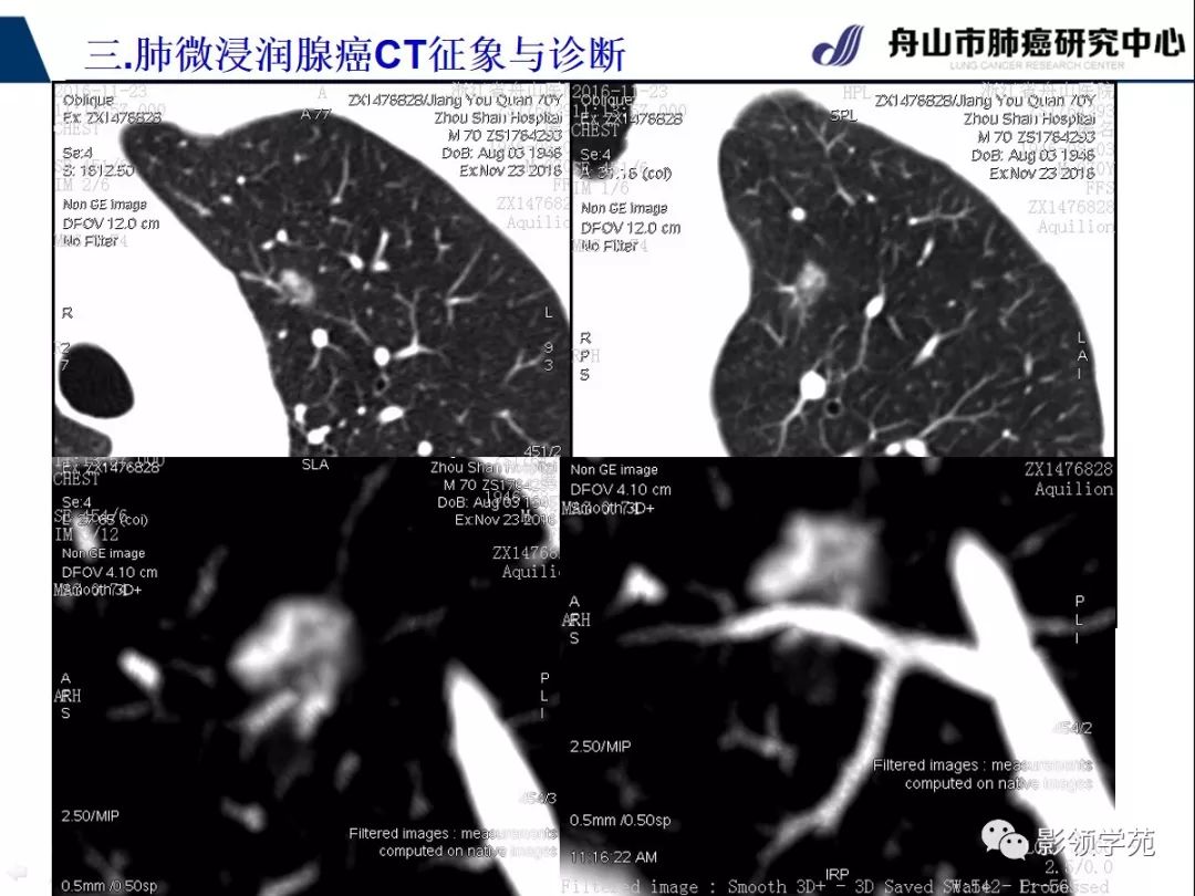 影像PPT - 【PPT】早期肺腺癌CT表现与处理策略探讨—微浸润肺腺癌-28 影像PPT - 【PPT】早期肺腺癌CT表现与处理策略探讨—微浸润肺腺癌-28