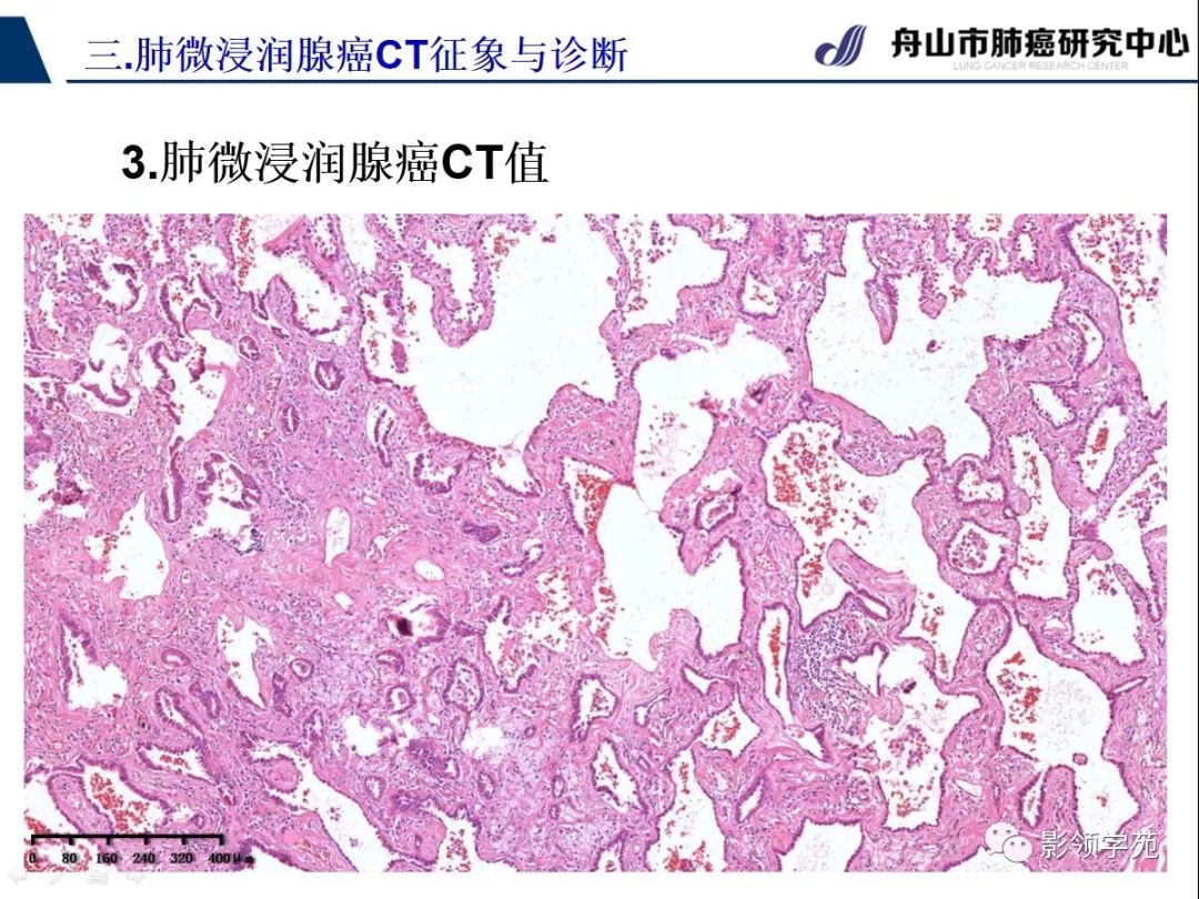 影像PPT - 【PPT】早期肺腺癌CT表现与处理策略探讨—微浸润肺腺癌-29 影像PPT - 【PPT】早期肺腺癌CT表现与处理策略探讨—微浸润肺腺癌-29