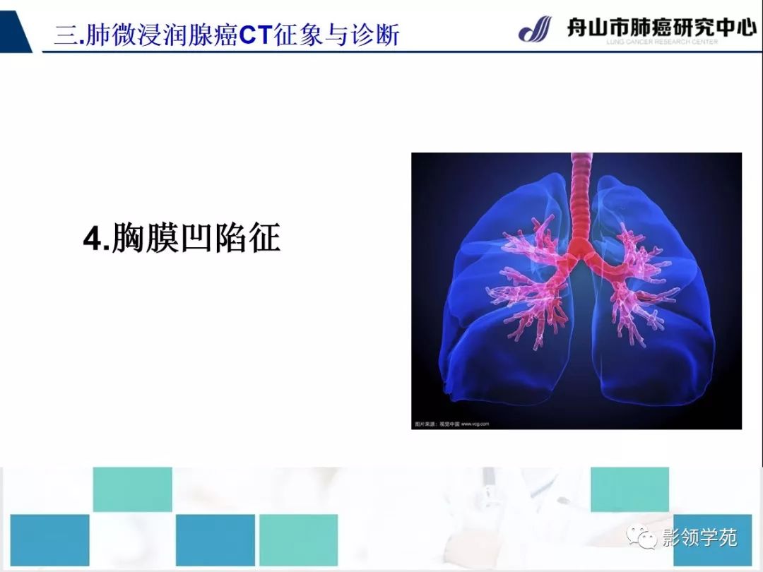 影像PPT - 【PPT】早期肺腺癌CT表现与处理策略探讨—微浸润肺腺癌-33 影像PPT - 【PPT】早期肺腺癌CT表现与处理策略探讨—微浸润肺腺癌-33