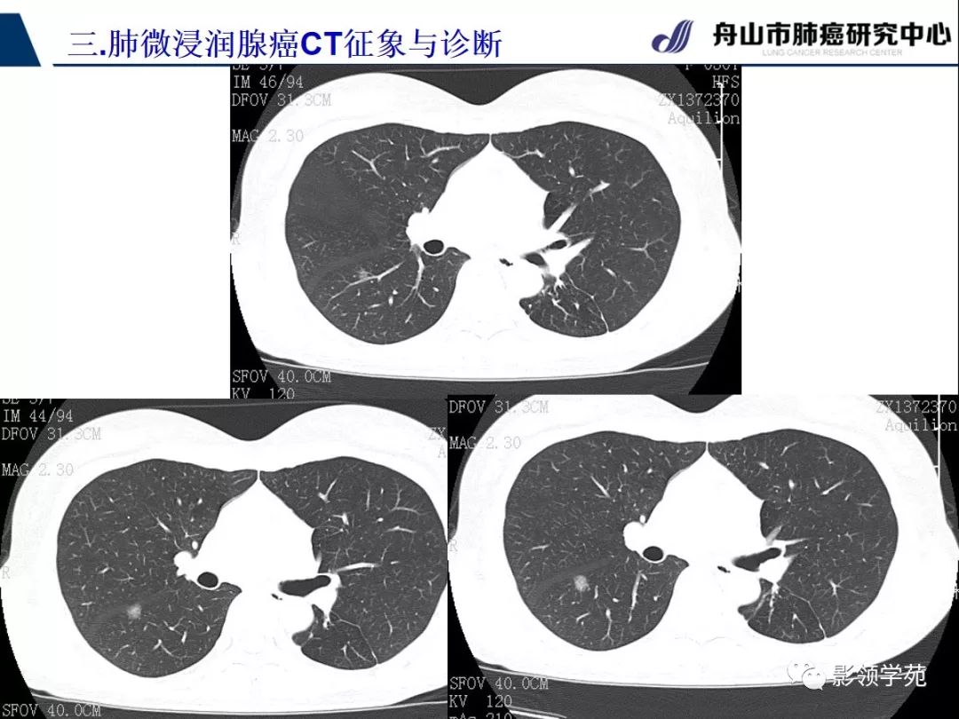 影像PPT - 【PPT】早期肺腺癌CT表现与处理策略探讨—微浸润肺腺癌-34 影像PPT - 【PPT】早期肺腺癌CT表现与处理策略探讨—微浸润肺腺癌-34