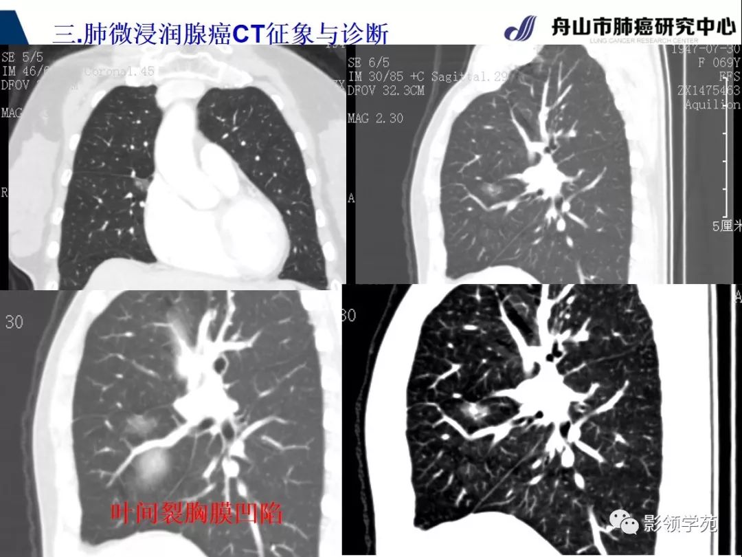 影像PPT - 【PPT】早期肺腺癌CT表现与处理策略探讨—微浸润肺腺癌-37 影像PPT - 【PPT】早期肺腺癌CT表现与处理策略探讨—微浸润肺腺癌-37