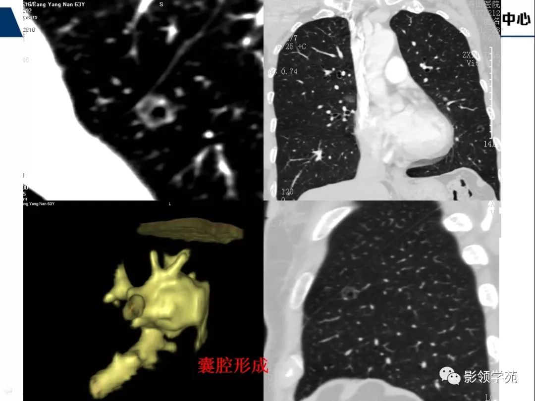 影像PPT - 【PPT】早期肺腺癌CT表现与处理策略探讨—微浸润肺腺癌-41 影像PPT - 【PPT】早期肺腺癌CT表现与处理策略探讨—微浸润肺腺癌-41