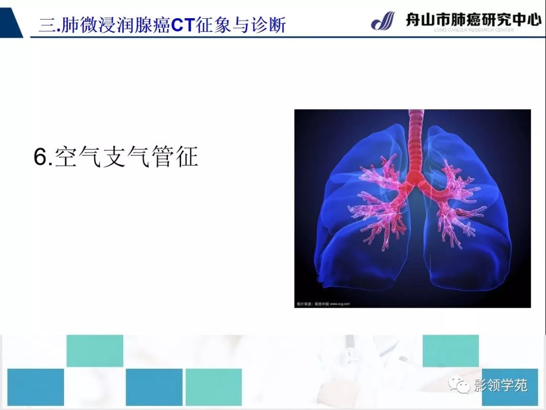 影像PPT - 【PPT】早期肺腺癌CT表现与处理策略探讨—微浸润肺腺癌-42 影像PPT - 【PPT】早期肺腺癌CT表现与处理策略探讨—微浸润肺腺癌-42