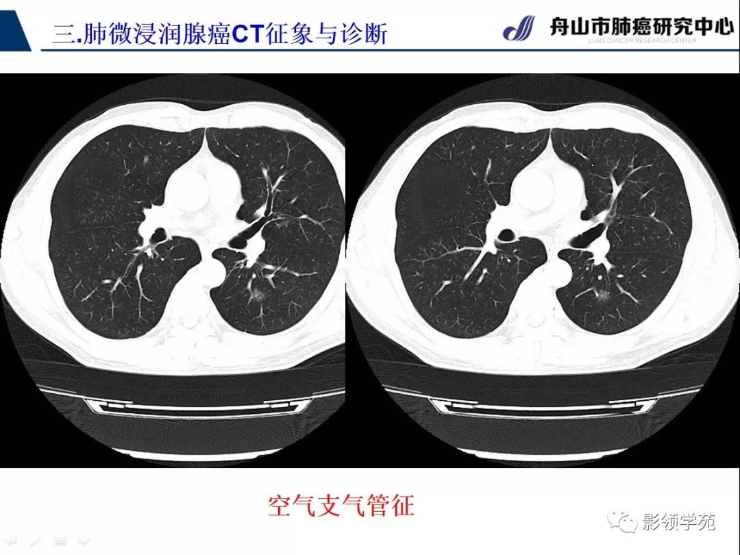 影像PPT - 【PPT】早期肺腺癌CT表现与处理策略探讨—微浸润肺腺癌-43 影像PPT - 【PPT】早期肺腺癌CT表现与处理策略探讨—微浸润肺腺癌-43
