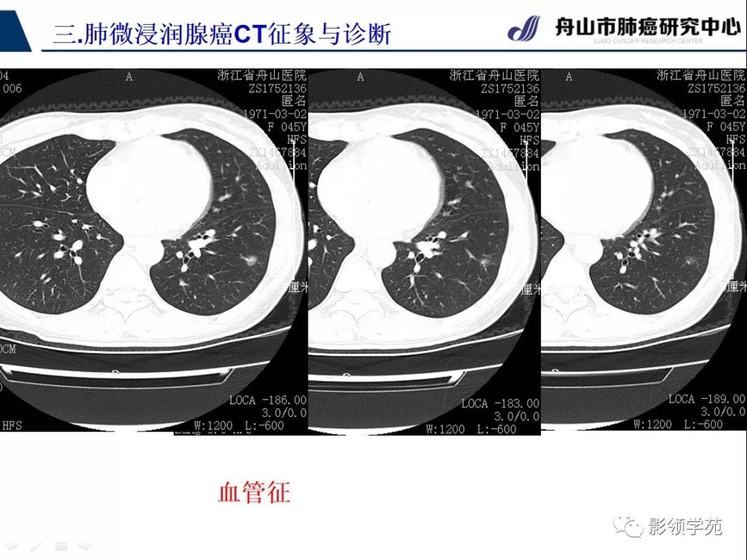 影像PPT - 【PPT】早期肺腺癌CT表现与处理策略探讨—微浸润肺腺癌-46 影像PPT - 【PPT】早期肺腺癌CT表现与处理策略探讨—微浸润肺腺癌-46