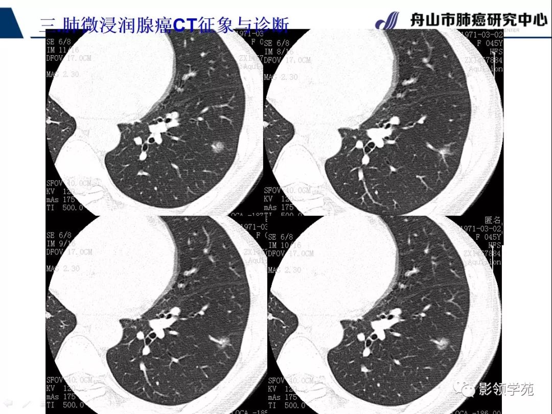 影像PPT - 【PPT】早期肺腺癌CT表现与处理策略探讨—微浸润肺腺癌-47 影像PPT - 【PPT】早期肺腺癌CT表现与处理策略探讨—微浸润肺腺癌-47