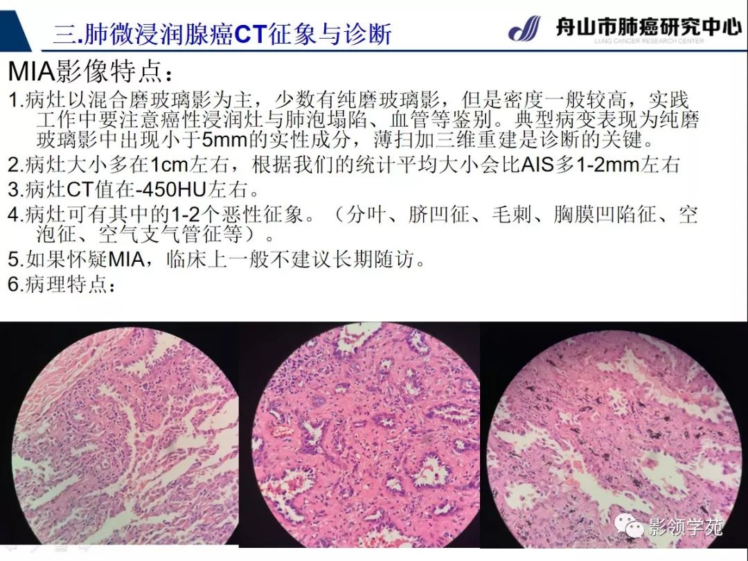 影像PPT - 【PPT】早期肺腺癌CT表现与处理策略探讨—微浸润肺腺癌-49 影像PPT - 【PPT】早期肺腺癌CT表现与处理策略探讨—微浸润肺腺癌-49