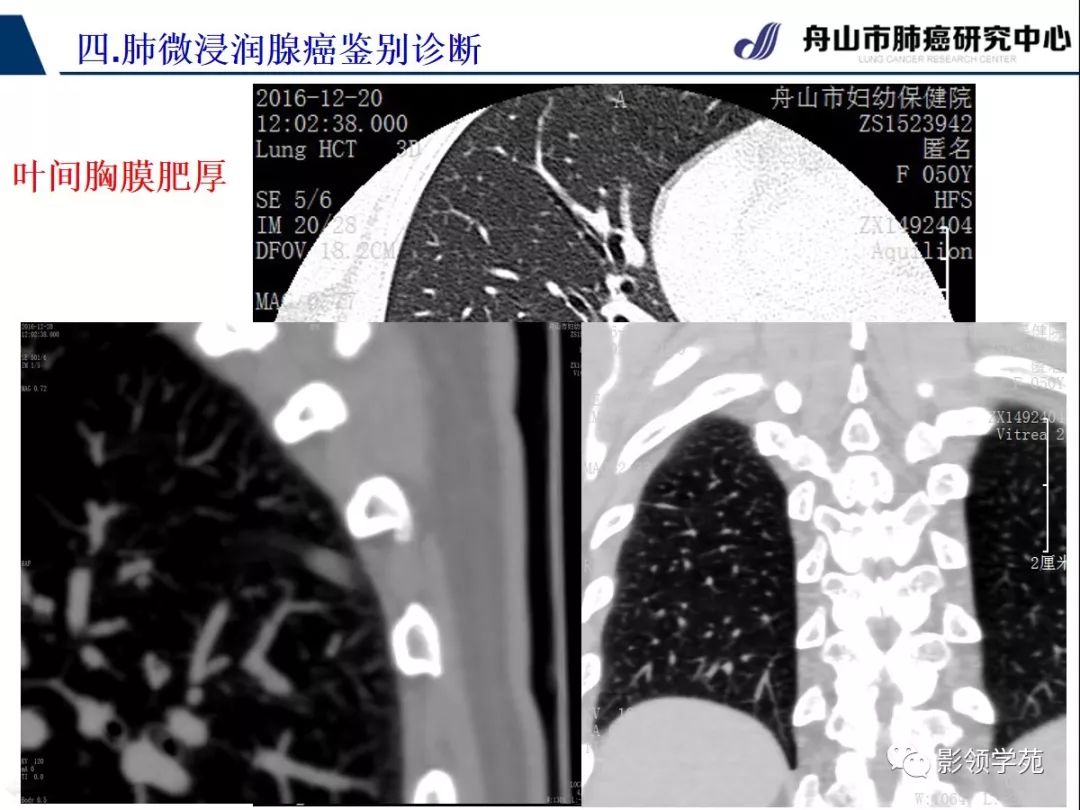 影像PPT - 【PPT】早期肺腺癌CT表现与处理策略探讨—微浸润肺腺癌-51 影像PPT - 【PPT】早期肺腺癌CT表现与处理策略探讨—微浸润肺腺癌-51