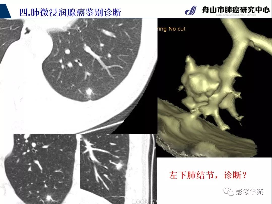 影像PPT - 【PPT】早期肺腺癌CT表现与处理策略探讨—微浸润肺腺癌-52 影像PPT - 【PPT】早期肺腺癌CT表现与处理策略探讨—微浸润肺腺癌-52