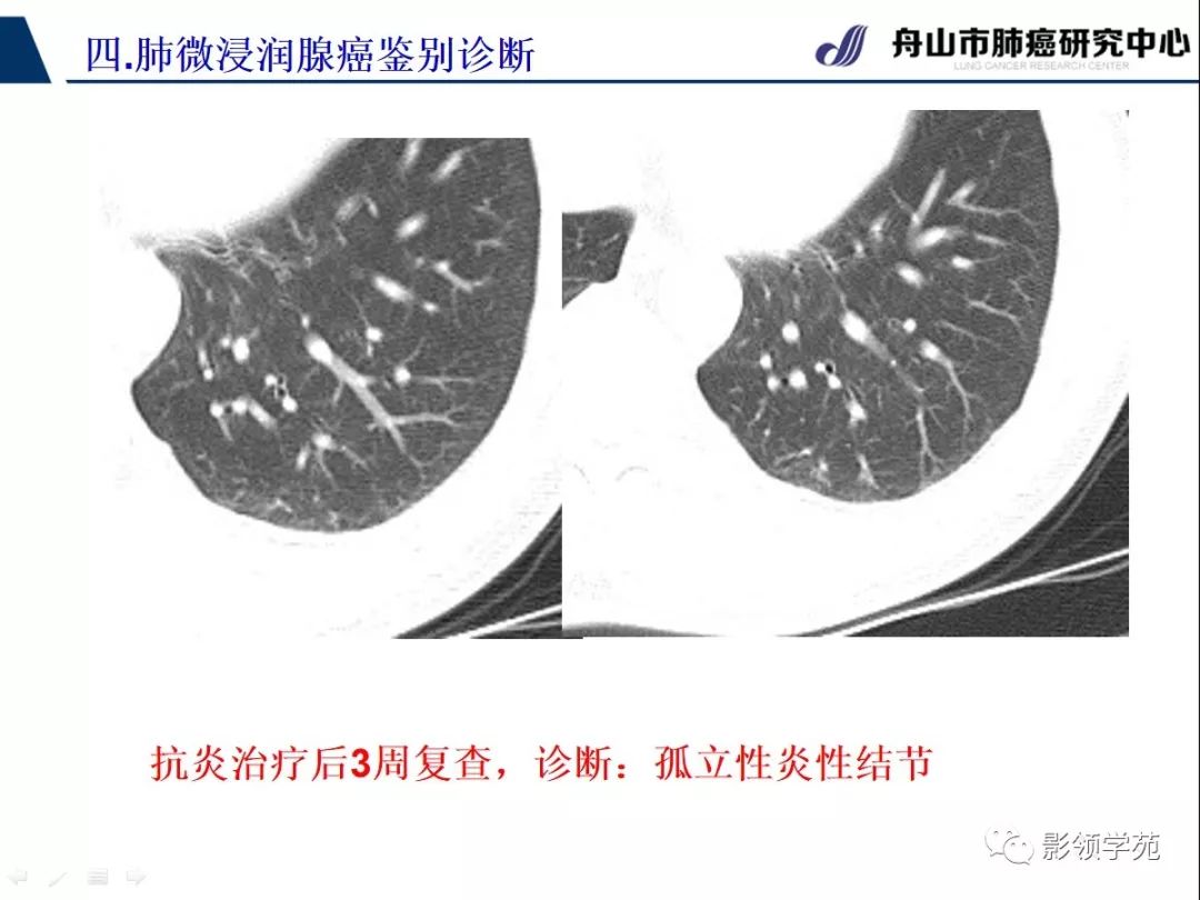 影像PPT - 【PPT】早期肺腺癌CT表现与处理策略探讨—微浸润肺腺癌-53 影像PPT - 【PPT】早期肺腺癌CT表现与处理策略探讨—微浸润肺腺癌-53
