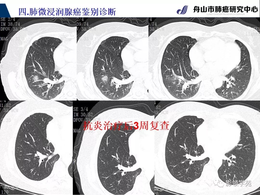 影像PPT - 【PPT】早期肺腺癌CT表现与处理策略探讨—微浸润肺腺癌-54 影像PPT - 【PPT】早期肺腺癌CT表现与处理策略探讨—微浸润肺腺癌-54