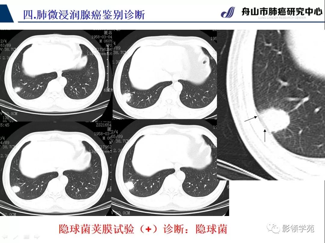 影像PPT - 【PPT】早期肺腺癌CT表现与处理策略探讨—微浸润肺腺癌-55 影像PPT - 【PPT】早期肺腺癌CT表现与处理策略探讨—微浸润肺腺癌-55