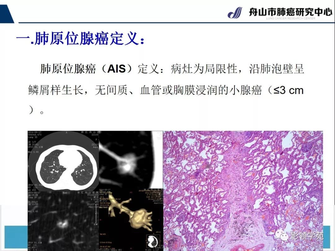 影像PPT - 【PPT】早期肺腺癌CT表现与处理策略探讨—肺原位腺癌-2 影像PPT - 【PPT】早期肺腺癌CT表现与处理策略探讨—肺原位腺癌-2