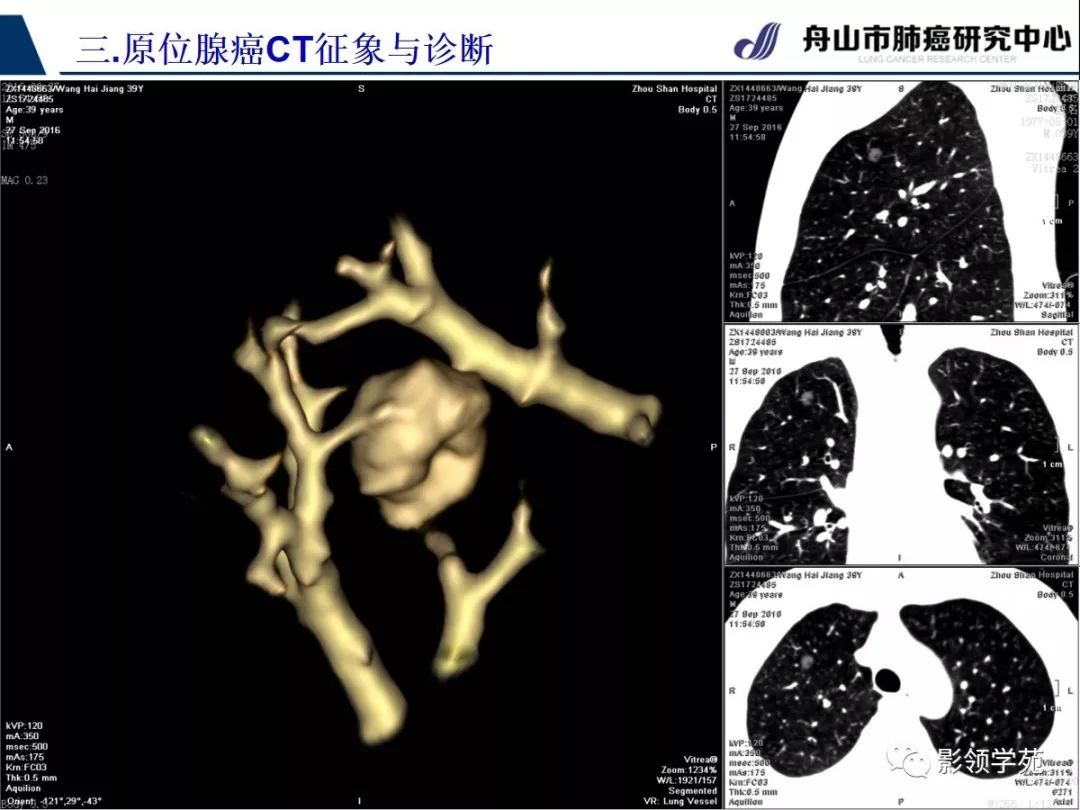 影像PPT - 【PPT】早期肺腺癌CT表现与处理策略探讨—肺原位腺癌-7 影像PPT - 【PPT】早期肺腺癌CT表现与处理策略探讨—肺原位腺癌-7