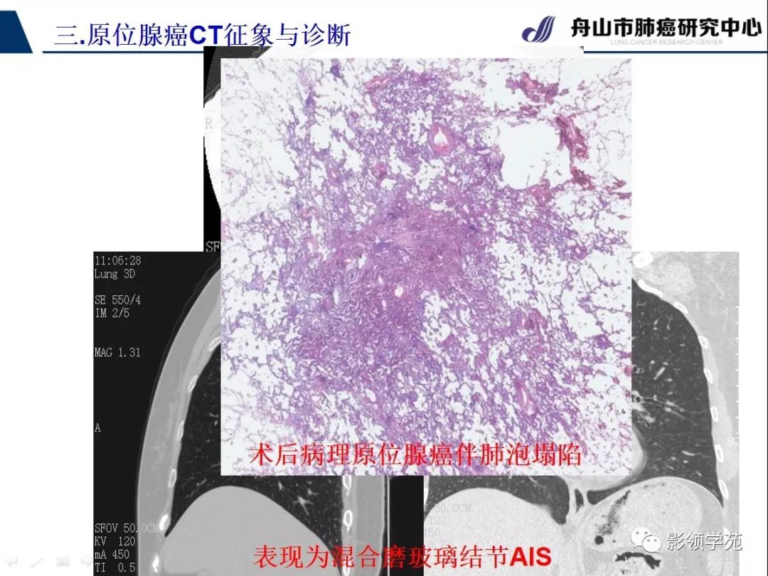 影像PPT - 【PPT】早期肺腺癌CT表现与处理策略探讨—肺原位腺癌-8 影像PPT - 【PPT】早期肺腺癌CT表现与处理策略探讨—肺原位腺癌-8