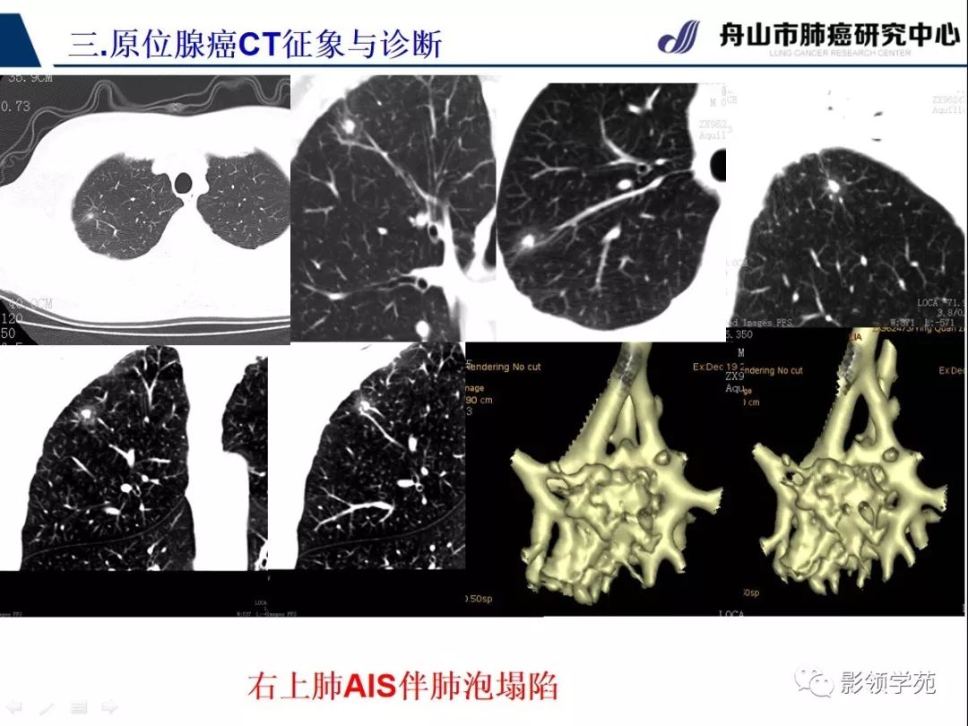 影像PPT - 【PPT】早期肺腺癌CT表现与处理策略探讨—肺原位腺癌-9 影像PPT - 【PPT】早期肺腺癌CT表现与处理策略探讨—肺原位腺癌-9