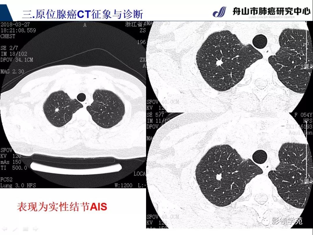 影像PPT - 【PPT】早期肺腺癌CT表现与处理策略探讨—肺原位腺癌-11 影像PPT - 【PPT】早期肺腺癌CT表现与处理策略探讨—肺原位腺癌-11