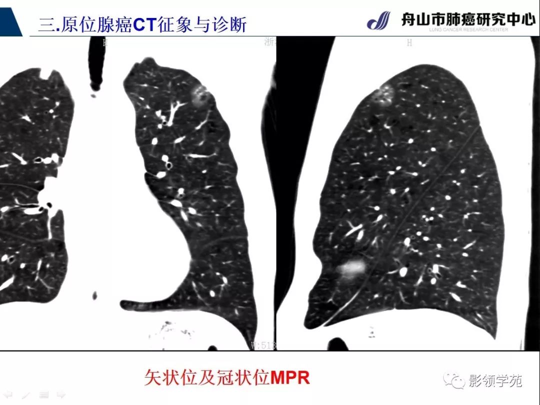 影像PPT - 【PPT】早期肺腺癌CT表现与处理策略探讨—肺原位腺癌-15 影像PPT - 【PPT】早期肺腺癌CT表现与处理策略探讨—肺原位腺癌-15