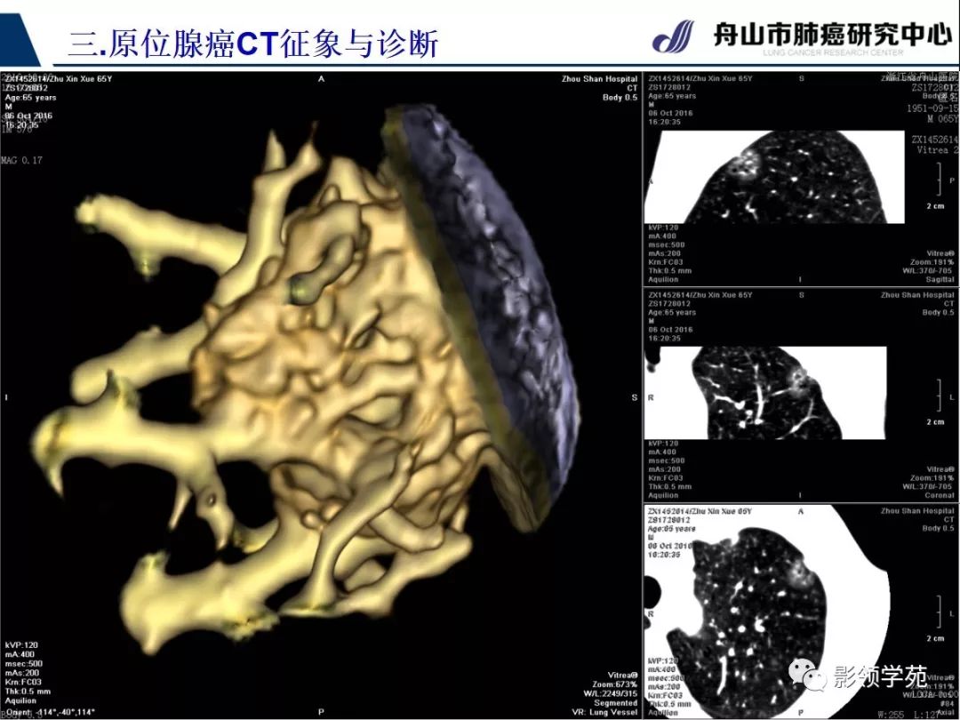 影像PPT - 【PPT】早期肺腺癌CT表现与处理策略探讨—肺原位腺癌-16 影像PPT - 【PPT】早期肺腺癌CT表现与处理策略探讨—肺原位腺癌-16