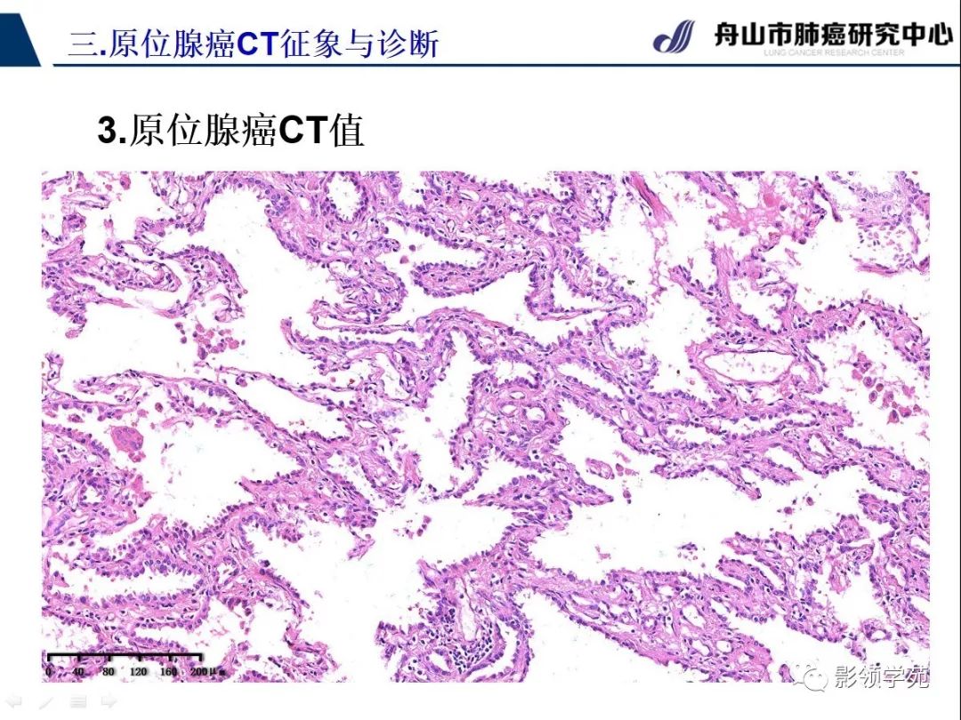 影像PPT - 【PPT】早期肺腺癌CT表现与处理策略探讨—肺原位腺癌-17 影像PPT - 【PPT】早期肺腺癌CT表现与处理策略探讨—肺原位腺癌-17