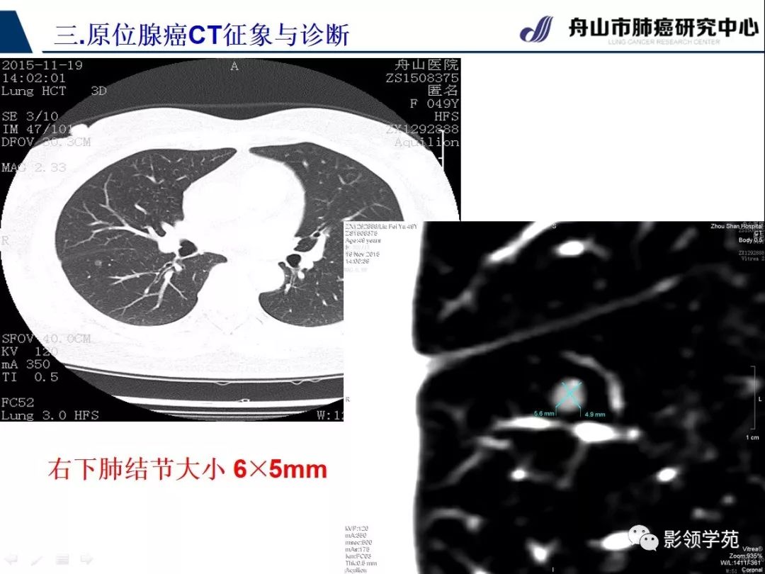 影像PPT - 【PPT】早期肺腺癌CT表现与处理策略探讨—肺原位腺癌-19 影像PPT - 【PPT】早期肺腺癌CT表现与处理策略探讨—肺原位腺癌-19