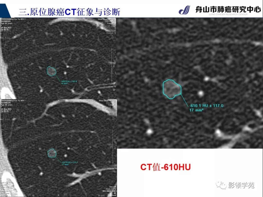 影像PPT - 【PPT】早期肺腺癌CT表现与处理策略探讨—肺原位腺癌-20 影像PPT - 【PPT】早期肺腺癌CT表现与处理策略探讨—肺原位腺癌-20