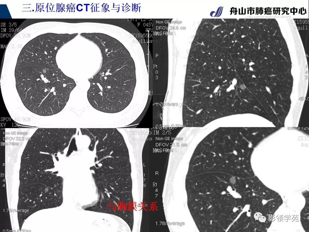 影像PPT - 【PPT】早期肺腺癌CT表现与处理策略探讨—肺原位腺癌-24 影像PPT - 【PPT】早期肺腺癌CT表现与处理策略探讨—肺原位腺癌-24