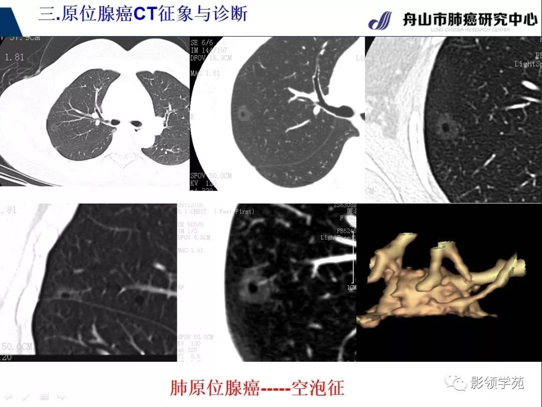 影像PPT - 【PPT】早期肺腺癌CT表现与处理策略探讨—肺原位腺癌-25 影像PPT - 【PPT】早期肺腺癌CT表现与处理策略探讨—肺原位腺癌-25