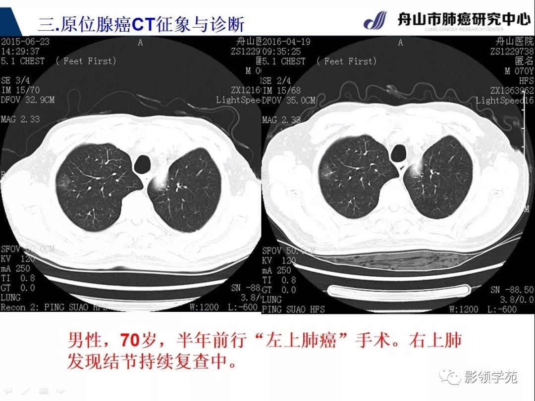 影像PPT - 【PPT】早期肺腺癌CT表现与处理策略探讨—肺原位腺癌-28 影像PPT - 【PPT】早期肺腺癌CT表现与处理策略探讨—肺原位腺癌-28