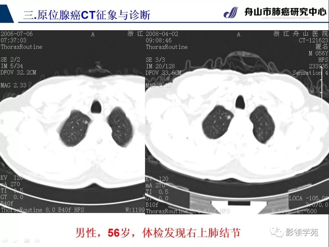 影像PPT - 【PPT】早期肺腺癌CT表现与处理策略探讨—肺原位腺癌-30 影像PPT - 【PPT】早期肺腺癌CT表现与处理策略探讨—肺原位腺癌-30