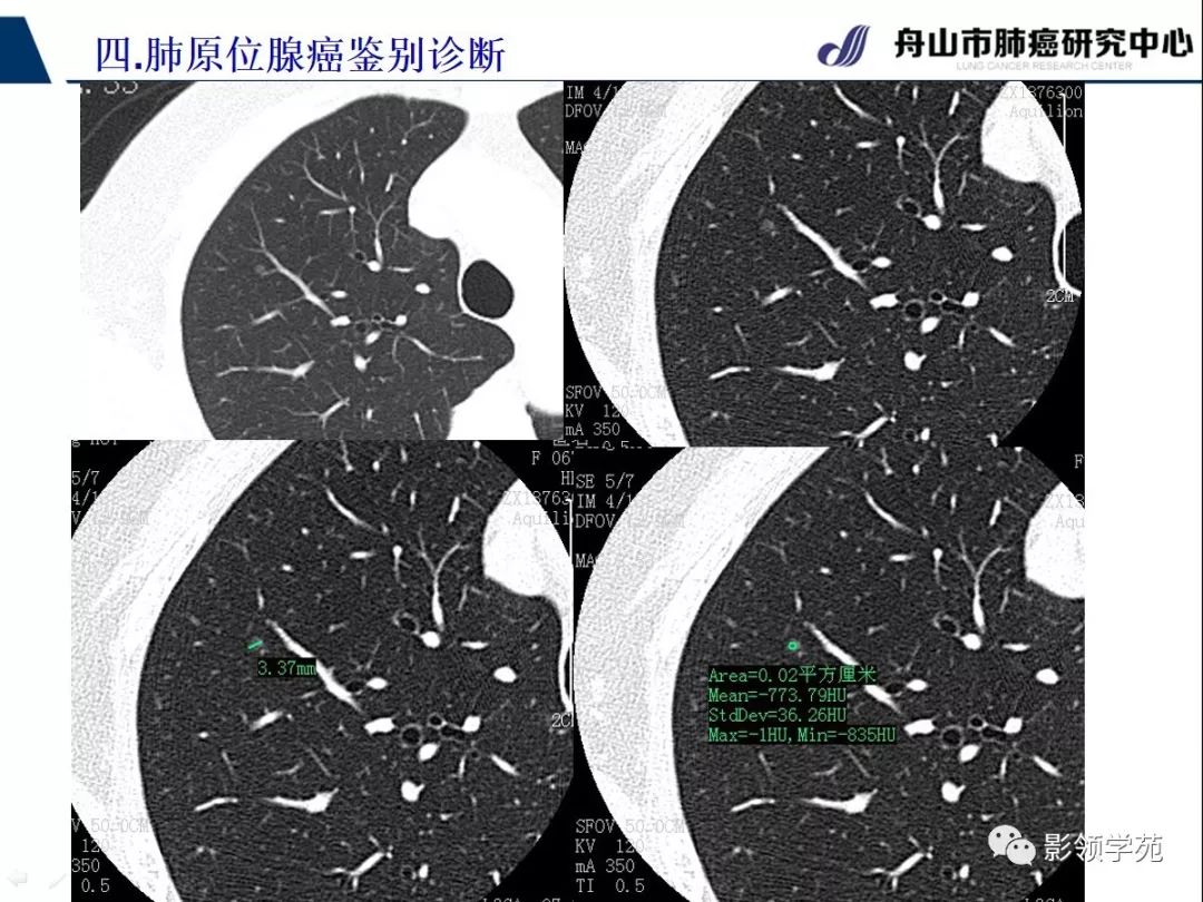 影像PPT - 【PPT】早期肺腺癌CT表现与处理策略探讨—肺原位腺癌-34 影像PPT - 【PPT】早期肺腺癌CT表现与处理策略探讨—肺原位腺癌-34