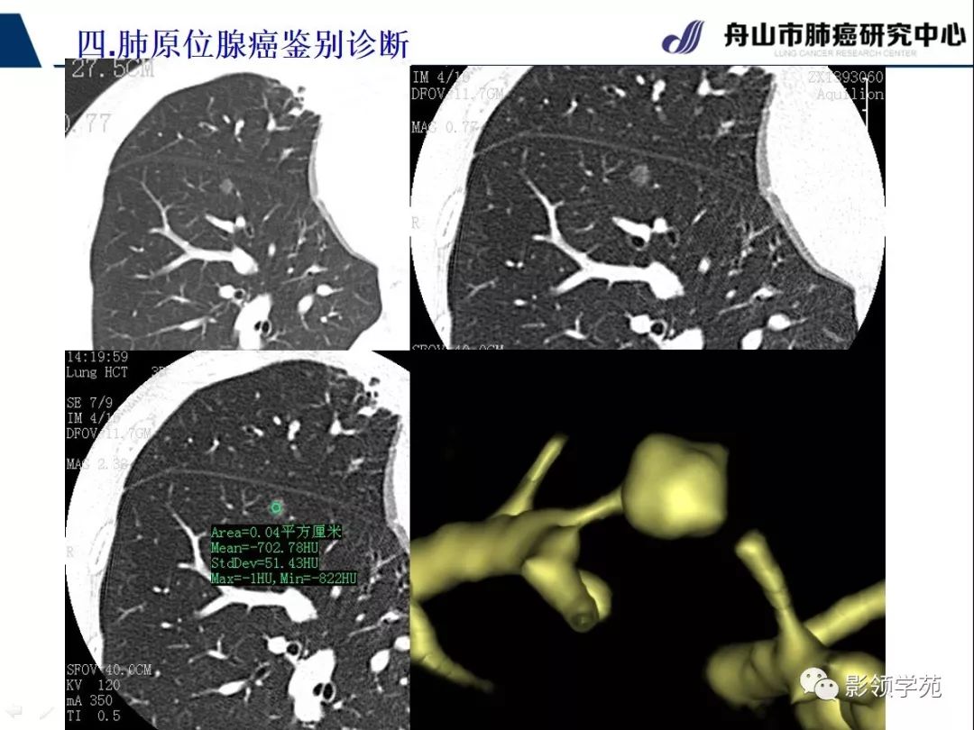 影像PPT - 【PPT】早期肺腺癌CT表现与处理策略探讨—肺原位腺癌-35 影像PPT - 【PPT】早期肺腺癌CT表现与处理策略探讨—肺原位腺癌-35