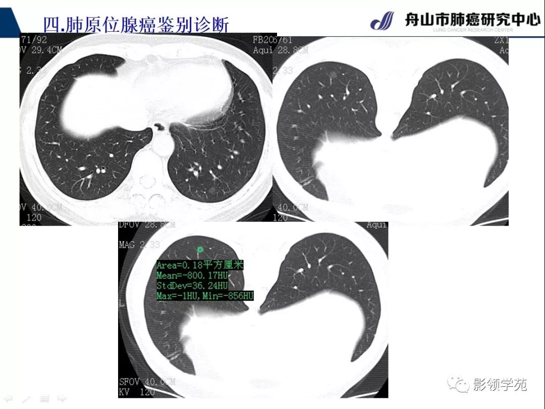 影像PPT - 【PPT】早期肺腺癌CT表现与处理策略探讨—肺原位腺癌-36 影像PPT - 【PPT】早期肺腺癌CT表现与处理策略探讨—肺原位腺癌-36