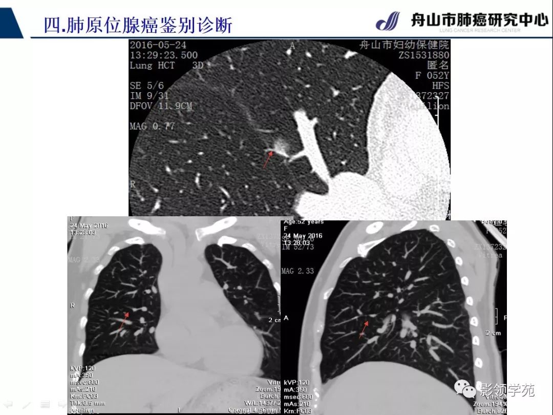 影像PPT - 【PPT】早期肺腺癌CT表现与处理策略探讨—肺原位腺癌-37 影像PPT - 【PPT】早期肺腺癌CT表现与处理策略探讨—肺原位腺癌-37