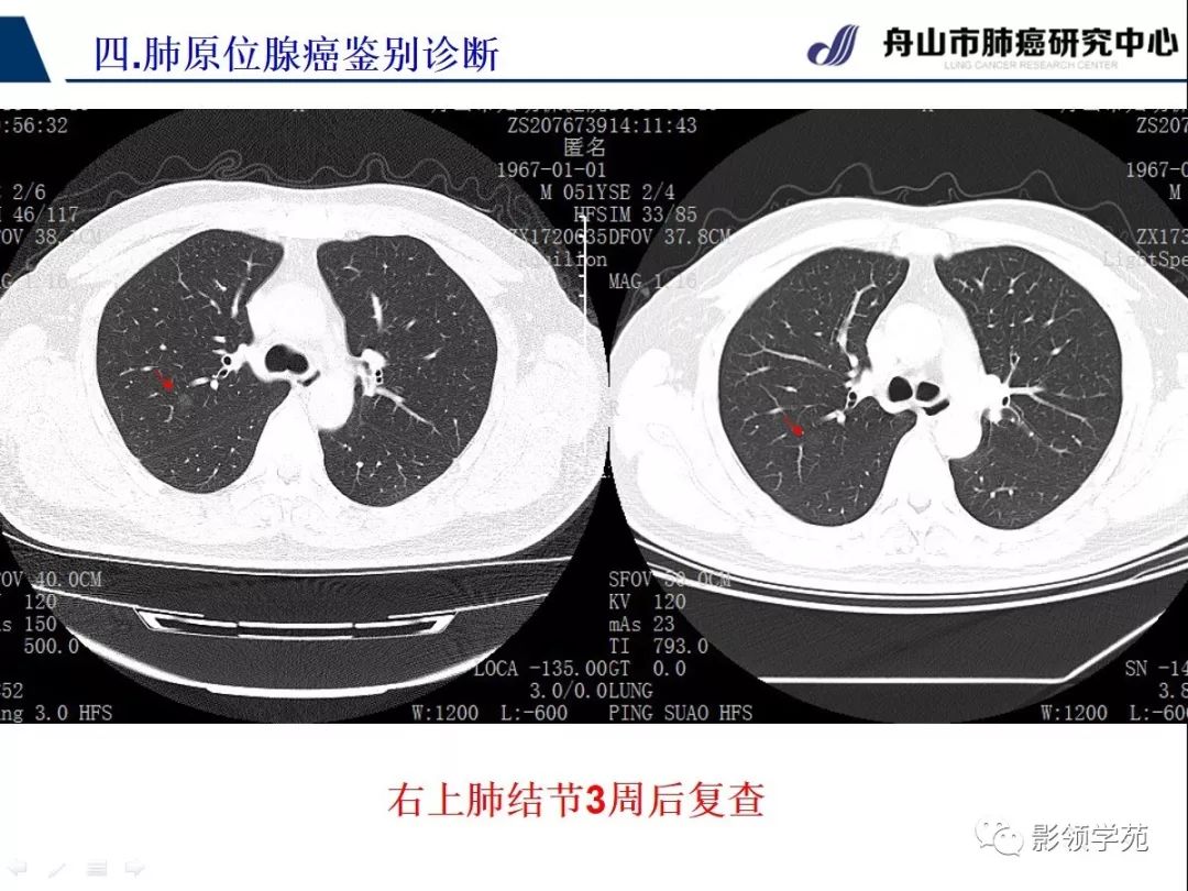 影像PPT - 【PPT】早期肺腺癌CT表现与处理策略探讨—肺原位腺癌-38 影像PPT - 【PPT】早期肺腺癌CT表现与处理策略探讨—肺原位腺癌-38