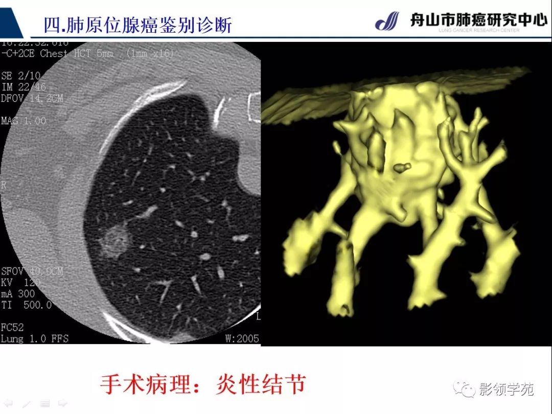 影像PPT - 【PPT】早期肺腺癌CT表现与处理策略探讨—肺原位腺癌-40 影像PPT - 【PPT】早期肺腺癌CT表现与处理策略探讨—肺原位腺癌-40