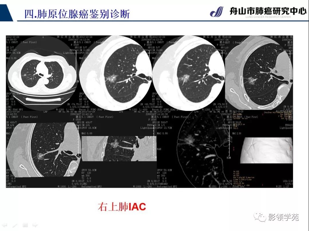 影像PPT - 【PPT】早期肺腺癌CT表现与处理策略探讨—肺原位腺癌-41 影像PPT - 【PPT】早期肺腺癌CT表现与处理策略探讨—肺原位腺癌-41