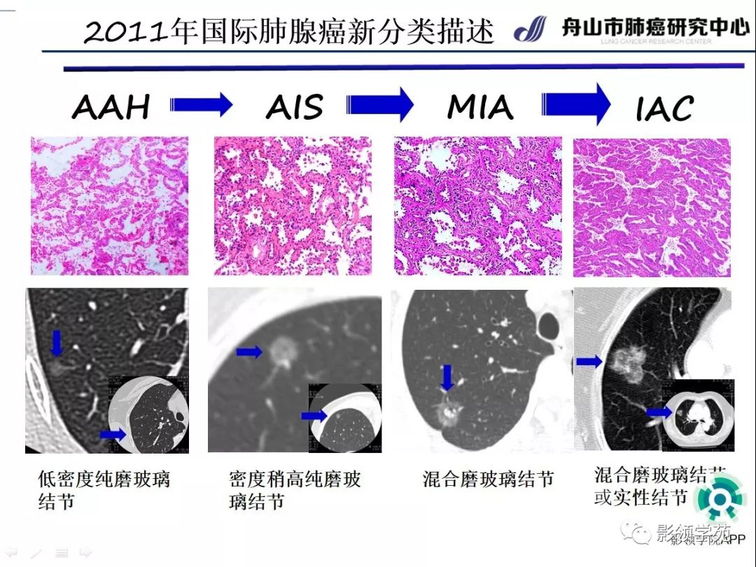 影像PPT - 【PPT】CT征象对早期肺腺癌亚型分型价值探讨（一）-4