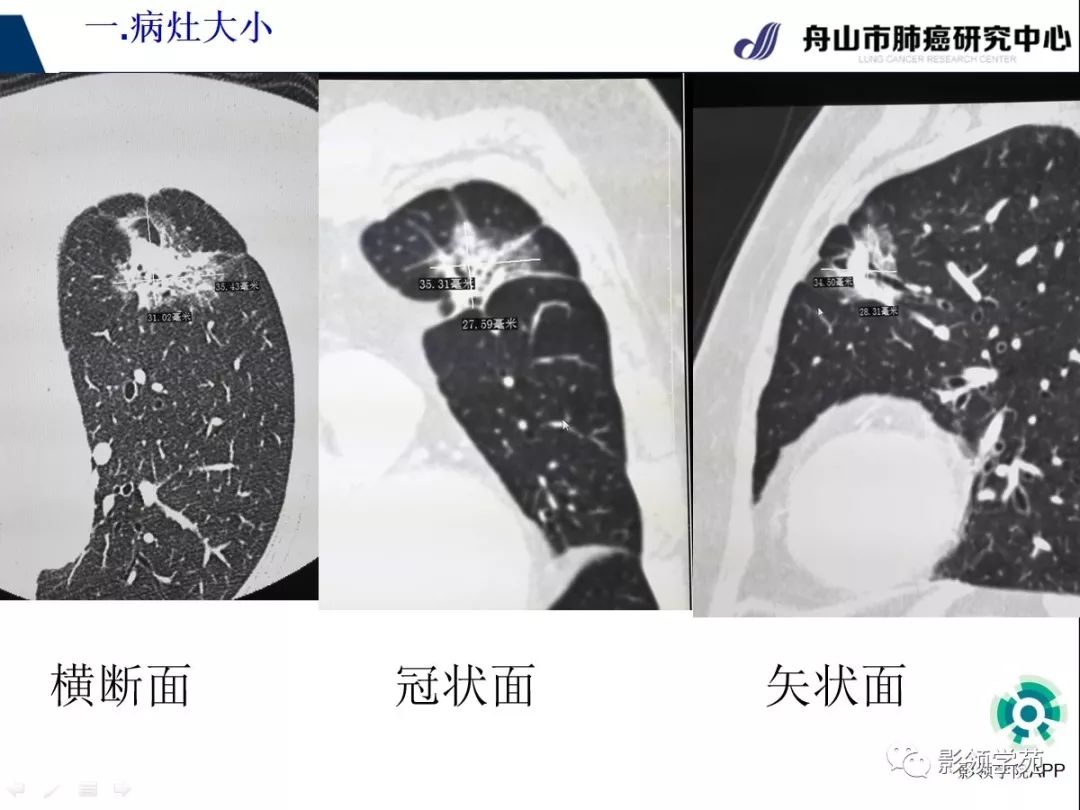 影像PPT - 【PPT】CT征象对早期肺腺癌亚型分型价值探讨（一）-9