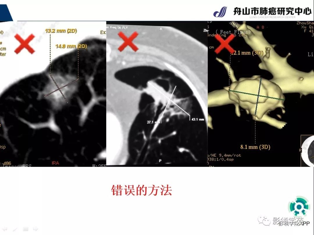 影像PPT - 【PPT】CT征象对早期肺腺癌亚型分型价值探讨（一）-10