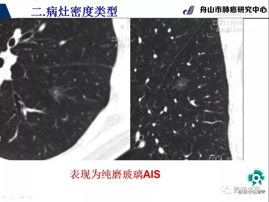 影像PPT - 【PPT】CT征象对早期肺腺癌亚型分型价值探讨（一）-20