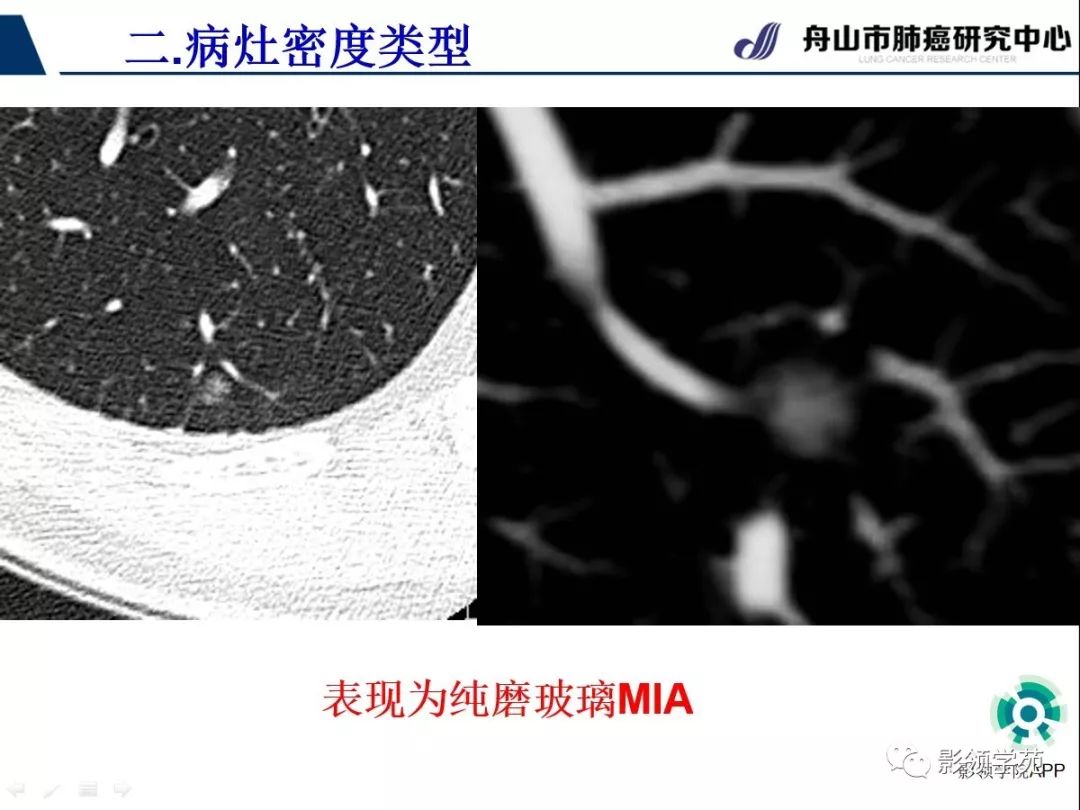 影像PPT - 【PPT】CT征象对早期肺腺癌亚型分型价值探讨（一）-21