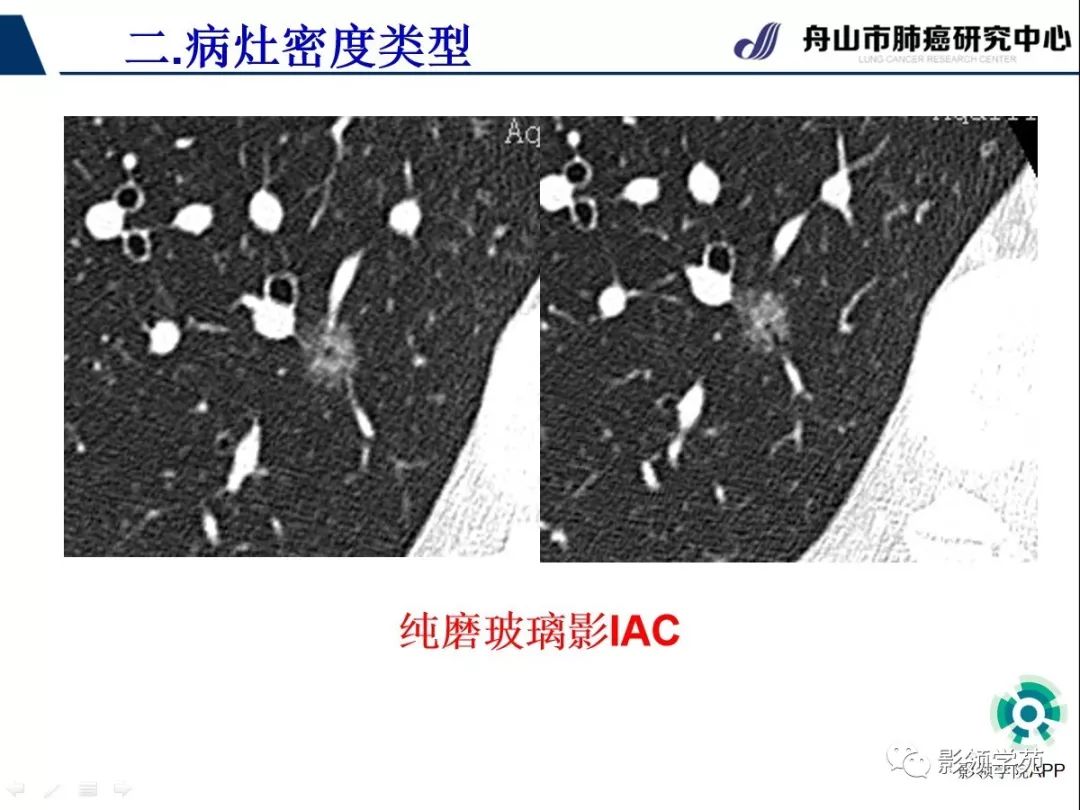 影像PPT - 【PPT】CT征象对早期肺腺癌亚型分型价值探讨（一）-22
