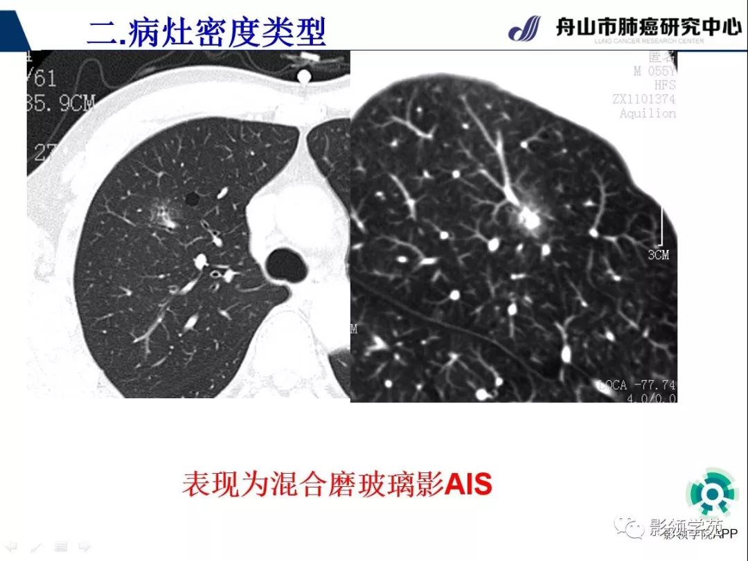 影像PPT - 【PPT】CT征象对早期肺腺癌亚型分型价值探讨（一）-23