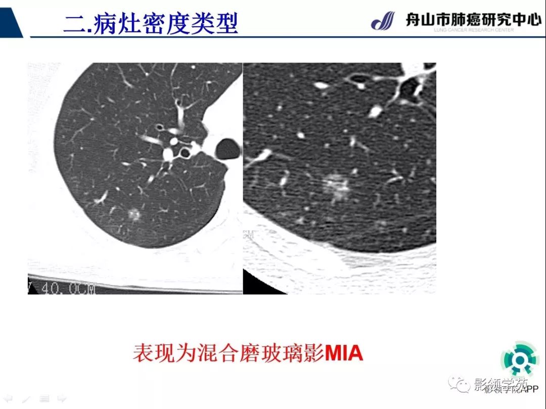 影像PPT - 【PPT】CT征象对早期肺腺癌亚型分型价值探讨（一）-24