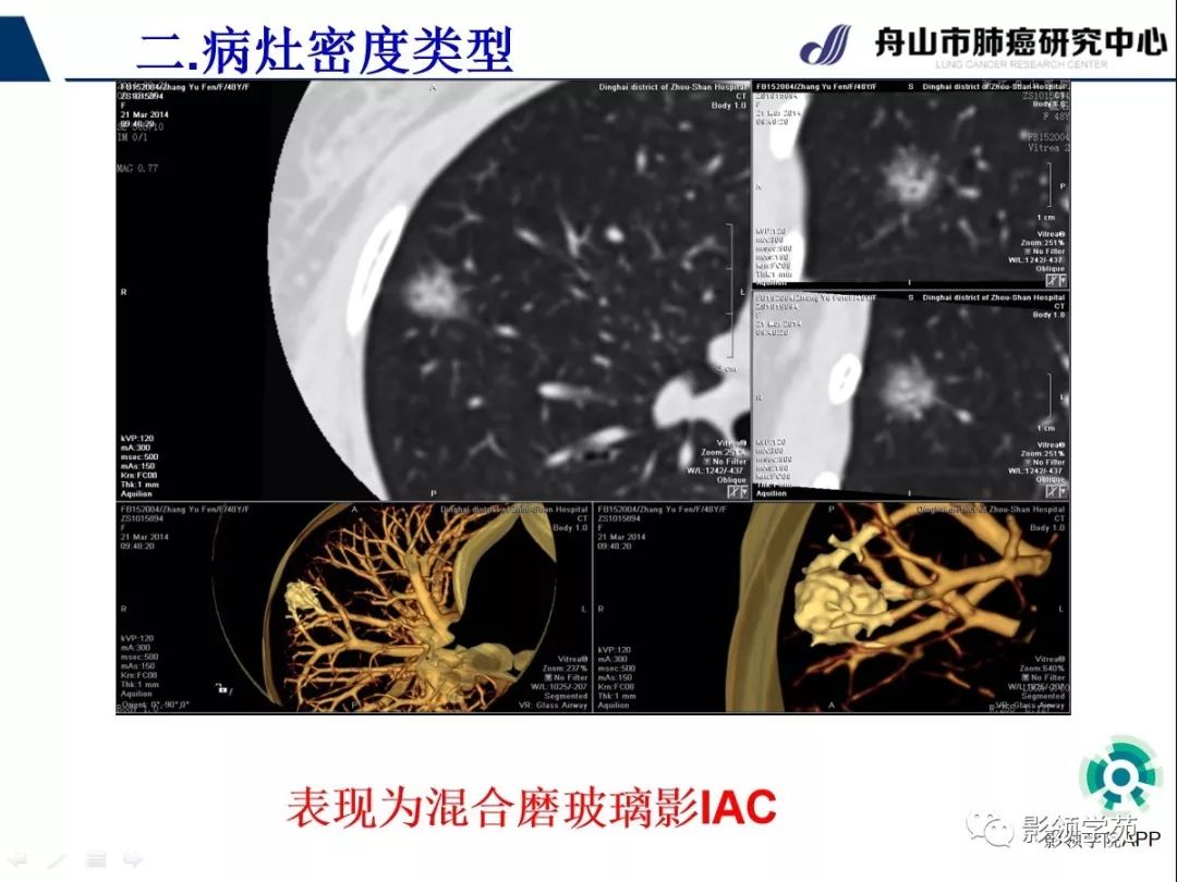 影像PPT - 【PPT】CT征象对早期肺腺癌亚型分型价值探讨（一）-25