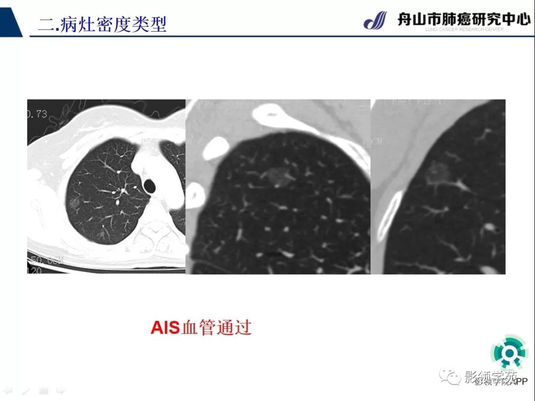影像PPT - 【PPT】CT征象对早期肺腺癌亚型分型价值探讨（一）-30