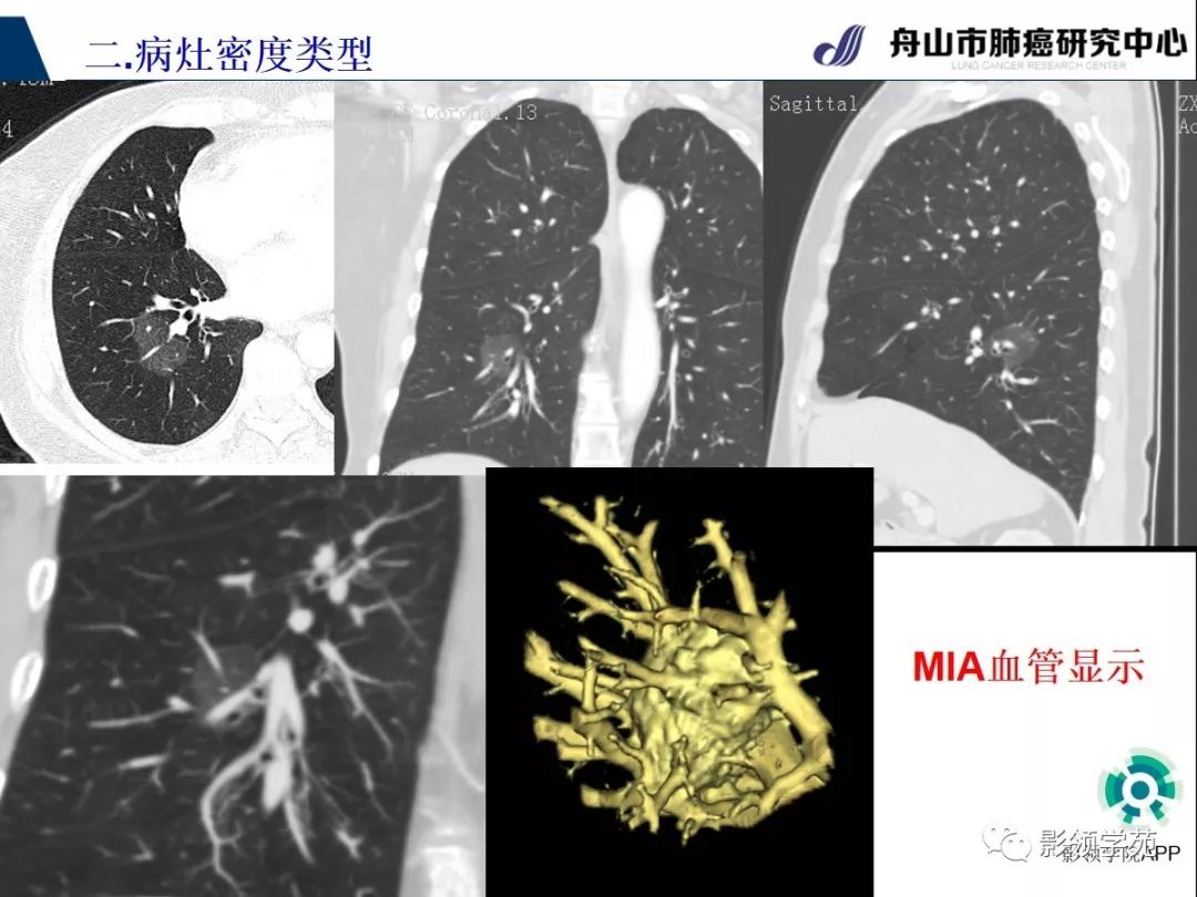 影像PPT - 【PPT】CT征象对早期肺腺癌亚型分型价值探讨（一）-31