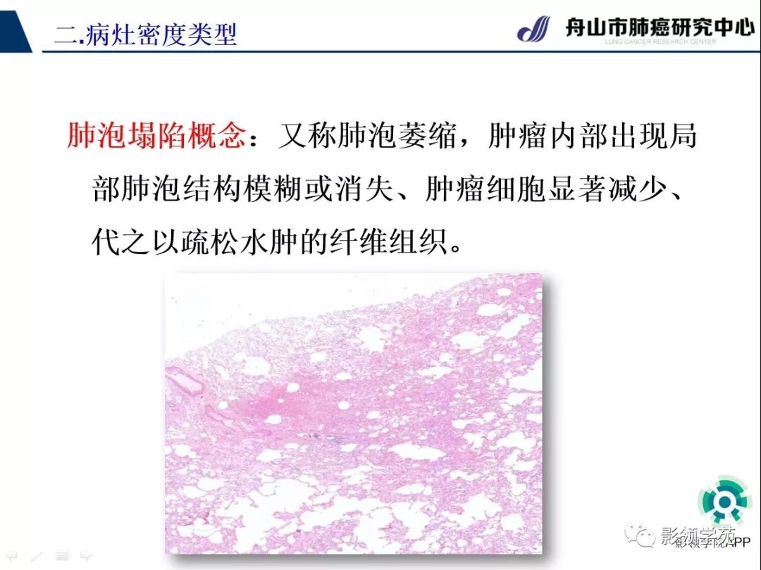 影像PPT - 【PPT】CT征象对早期肺腺癌亚型分型价值探讨（一）-37