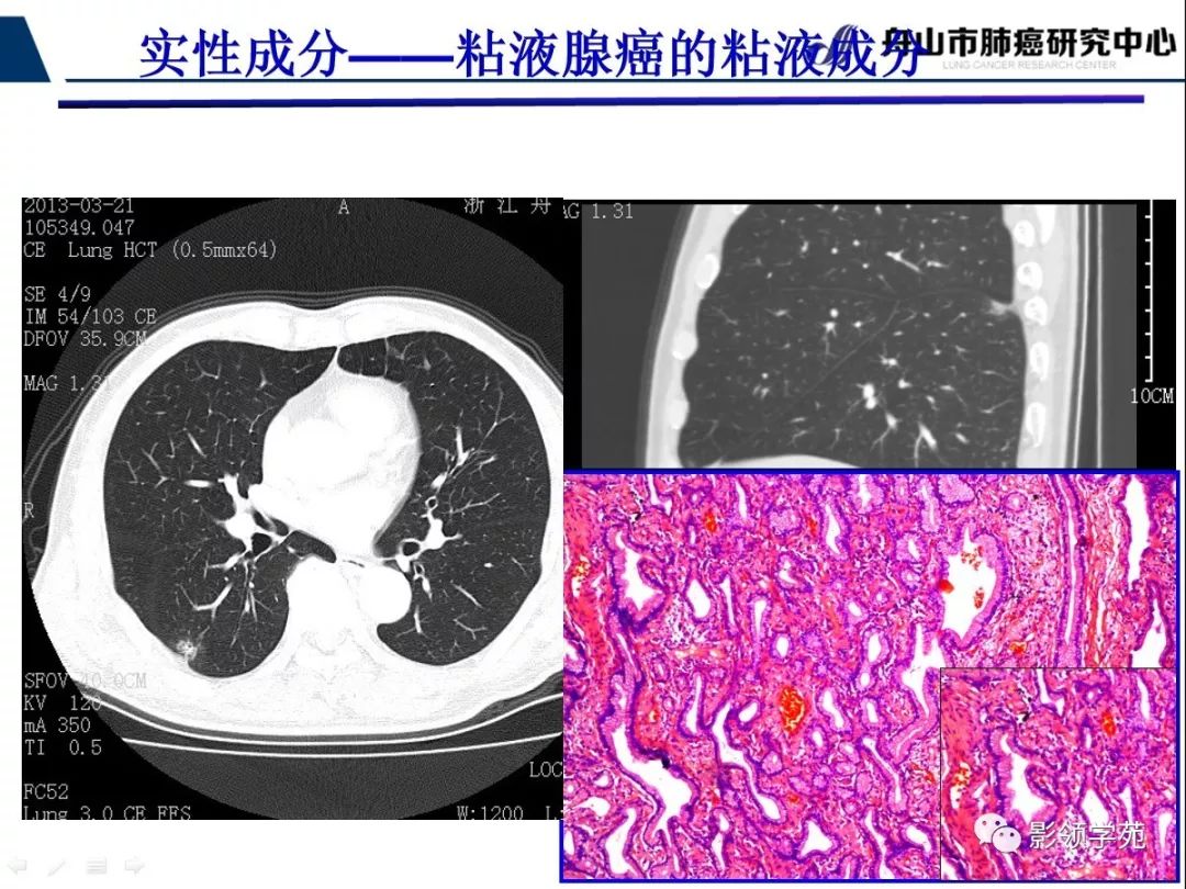 影像PPT - 【PPT】CT征象对早期肺腺癌亚型分型价值探讨（一）-39